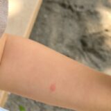 子どもの腕の虫さされ
