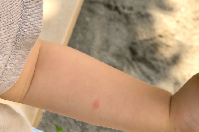 子どもの腕の虫さされ