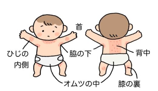 そもそも「あせも」って何？汗の季節の予防とケア【登録販売者がやさしく解説】