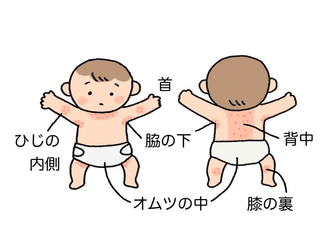 赤ちゃんのあせも